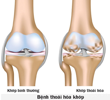 thoai-hoa-khop-1