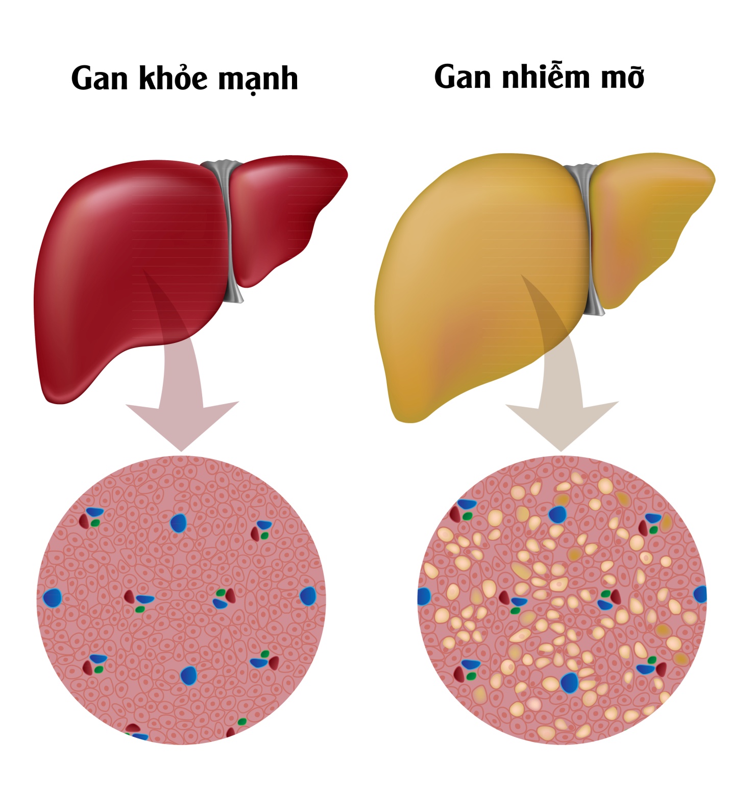 ăn quá nhiều đường sẽ gây ra tình trạng gan nhiễm mỡ