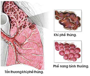 cach-nhan-biet-benh-ho-hap-cap-tinh-o-nguoi-cao-tuoi-1