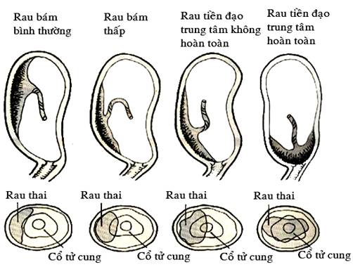 nhung-nguy-hiem-cua-nhau-tien-dao-me-bau-nen-biet-1