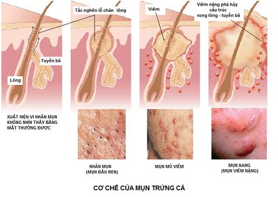 nhung-phuong-phap-tri-mun-trung-ca-hieu-qua-4