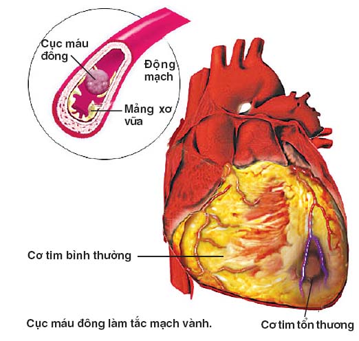 xo-vua-dong-mach-ngo-vao-cua-nhieu-benh-chung-2