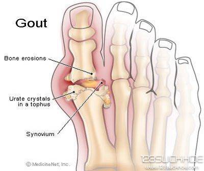 yeu-to-lam-tang-nguy-co-benh-gut-1