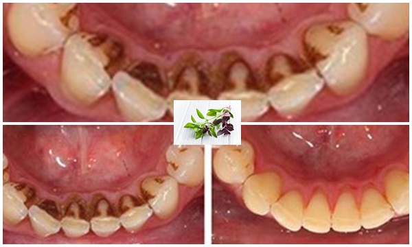 Giúp bạn “Quét sạch” mảng báng, ố vàng trên răng chỉ với chưa đến 2 ngàn đồng