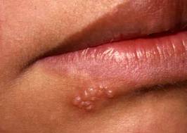 Giúp bạn Bệnh do virut Herpes: Chữa trị thế nào?