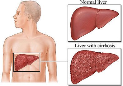 Giúp bạn Bệnh Viêm gan B là gì ?