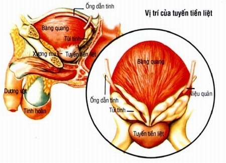 Giúp bạn Bệnh viêm tuyến tiền liệt ở nam giới là gì và cách đề phòng như thế nào?