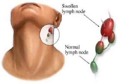 Giúp bạn Các cách điều trị ung thư hạch