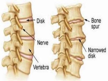 Giúp bạn Cách cách phòng ngừa thoái hóa khớp