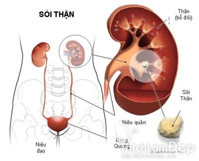 Giúp bạn Điều trị sỏi thận thế nào?