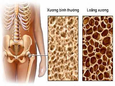 Giúp bạn Hiểu đúng để phòng ngừa bệnh xốp xương?