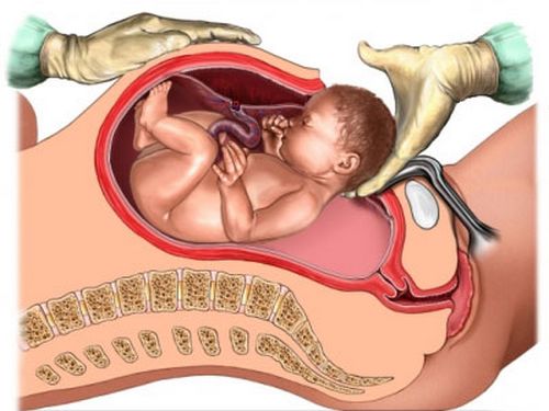 Giúp bạn Mổ đẻ nhiều lần làm tăng nguy cơ biến chứng