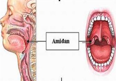 Giúp bạn Nên cắt bỏ Amidan khi nào?