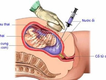 Giúp bạn Những dấu hiệu nguy cơ cần chọc ối