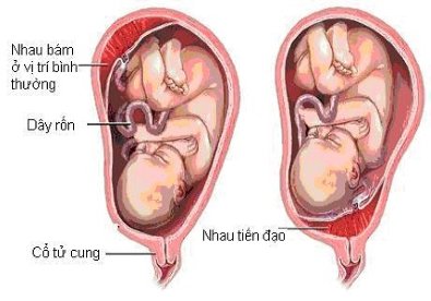 Giúp bạn Những nguy hiểm của nhau tiền đạo mẹ bầu nên biết