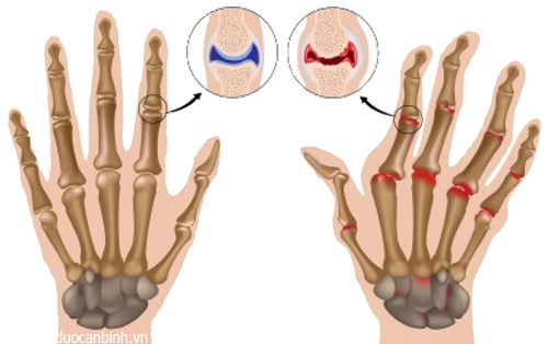 Giúp bạn Thoái hóa khớp bàn tay và cách phòng ngừa như thế nào?