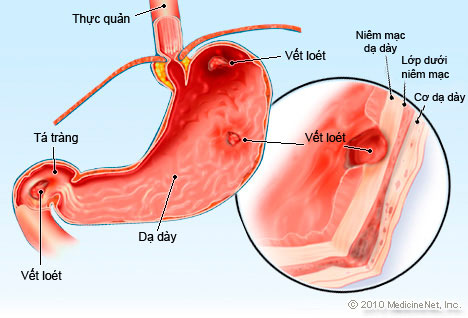 Giúp bạn Viêm loét dạ dày?