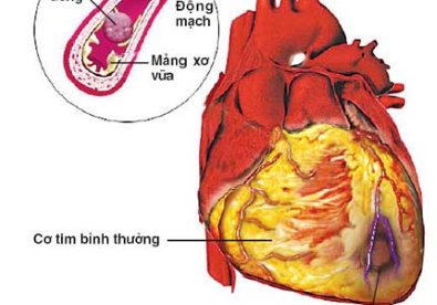 Giúp bạn Xơ vữa động mạch - ngõ vào của nhiều bệnh chứng