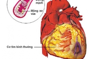 Giúp bạn Xơ vữa động mạch - ngõ vào của nhiều bệnh chứng