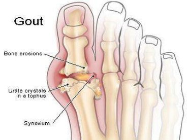 Giúp bạn Yếu tố làm tăng nguy cơ bệnh gút