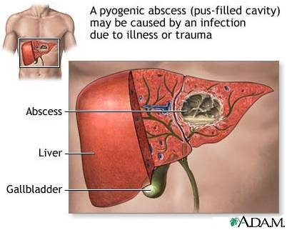 Giúp bạn Áp xe gan: Nguyên nhân, triệu chứng