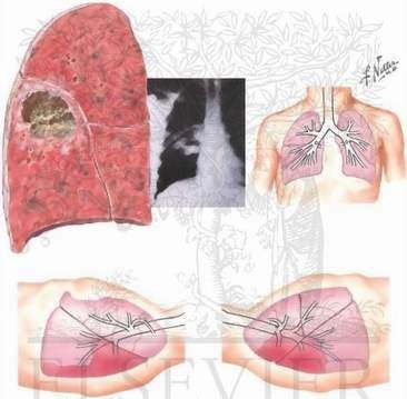 Giúp bạn Áp-xe phổi