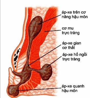 Giúp bạn Áp xe vùng hậu môn-trực tràng: Chẩn đoán, điều trị