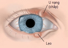 Giúp bạn Bệnh chắp và lẹo mắt