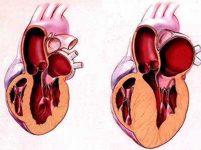 Giúp bạn Bệnh cơ tim phì đại