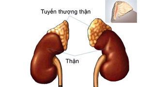 Giúp bạn Bệnh cường aldosterone