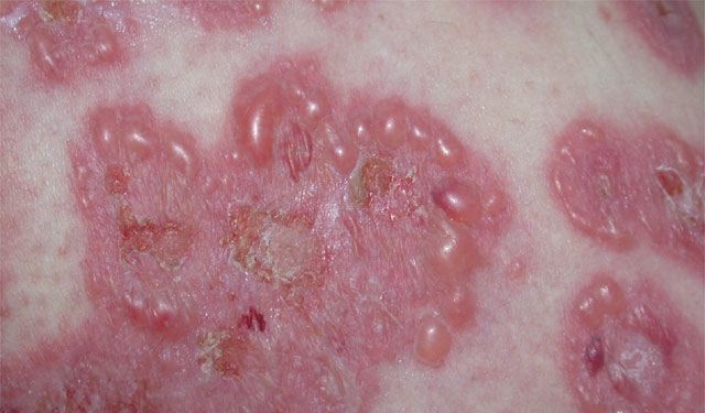 Giúp bạn Bệnh da bọng nước tự miễn Pemphigus