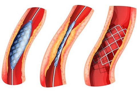 Giúp bạn Bệnh động mạch ngoại vi: Chẩn đoán, biến chứng