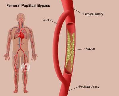 Giúp bạn Bệnh động mạch ngoại vi: Nguyên nhân, triệu chứng 