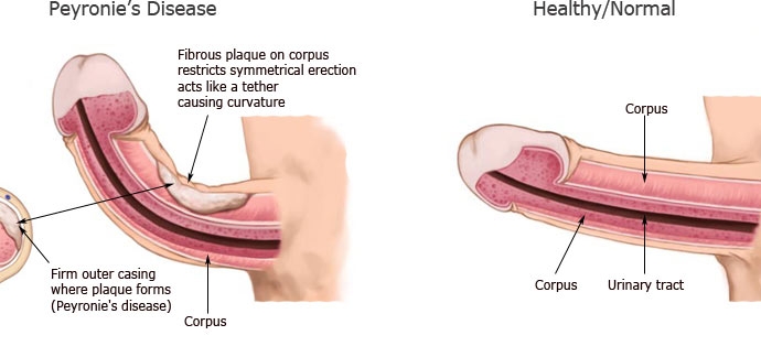 Giúp bạn Bệnh lạ: Bệnh Peyronie