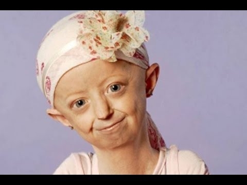 Giúp bạn Bệnh lạ: Bệnh Progeria