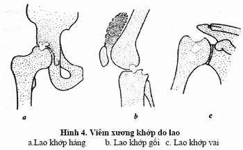 Giúp bạn Bệnh lao xương khớp