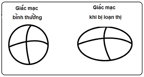 Giúp bạn Bệnh loạn thị