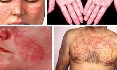 Giúp bạn Bệnh lupus ban đỏ