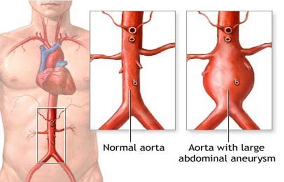 Giúp bạn Bệnh phình động mạch chủ