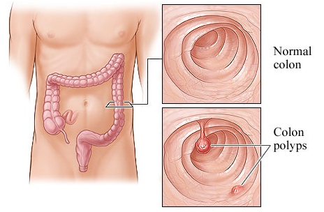 Giúp bạn Bệnh polyp đại tràng