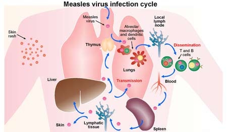 Giúp bạn Bệnh sởi: Con đường lây nhiễm, cách phòng ngừa