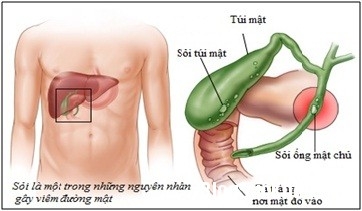 Giúp bạn Bệnh sỏi mật