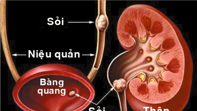 Giúp bạn Bệnh sỏi tiết niệu