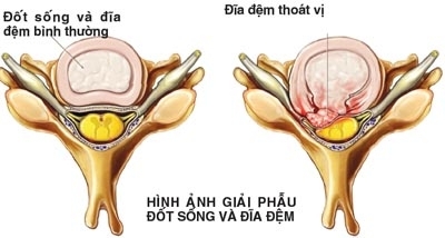 Giúp bạn Bệnh thoát vị đĩa đệm: Hậu quả và cách phòng bệnh