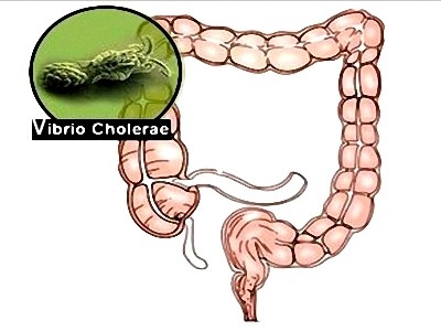 Giúp bạn Bệnh tiêu chảy: Triệu chứng, chẩn đoán và phòng ngừa