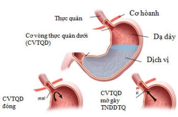 Giúp bạn Bệnh trào ngược dạ dày - thực quản