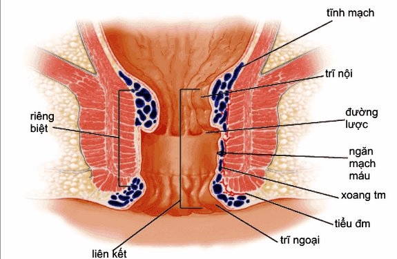 Giúp bạn Bệnh trĩ