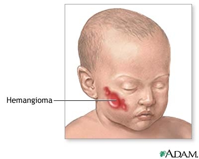 Giúp bạn Bệnh u máu ở trẻ em: Triệu chứng và chẩn đoán bệnh