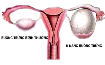 Giúp bạn Bệnh u nang buồng trứng: Nguyên nhân, triệu chứng