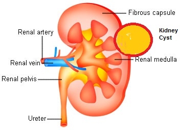 Giúp bạn Bệnh u nang thận